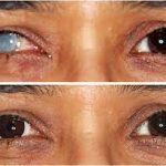 لنز بلک پوپیل قابل استفاده برای کدورت عنبیه - Image 3